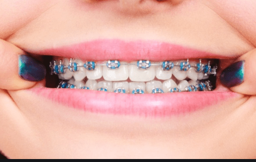 What Is Average Cost Of Braces Cost Of Braces For Adult And Children   Capture 46 